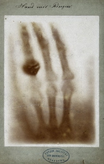First medical X-ray - The hand of Wilhelm Röntgen's wife