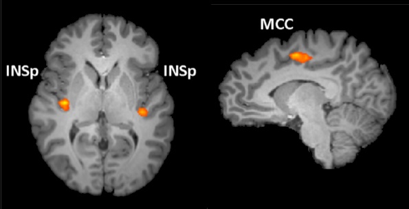 Brain regions affected by math anxiety